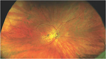 UWF color image of a patient with geographic atrophy demonstrating drusen.
Image courtesy of Optos