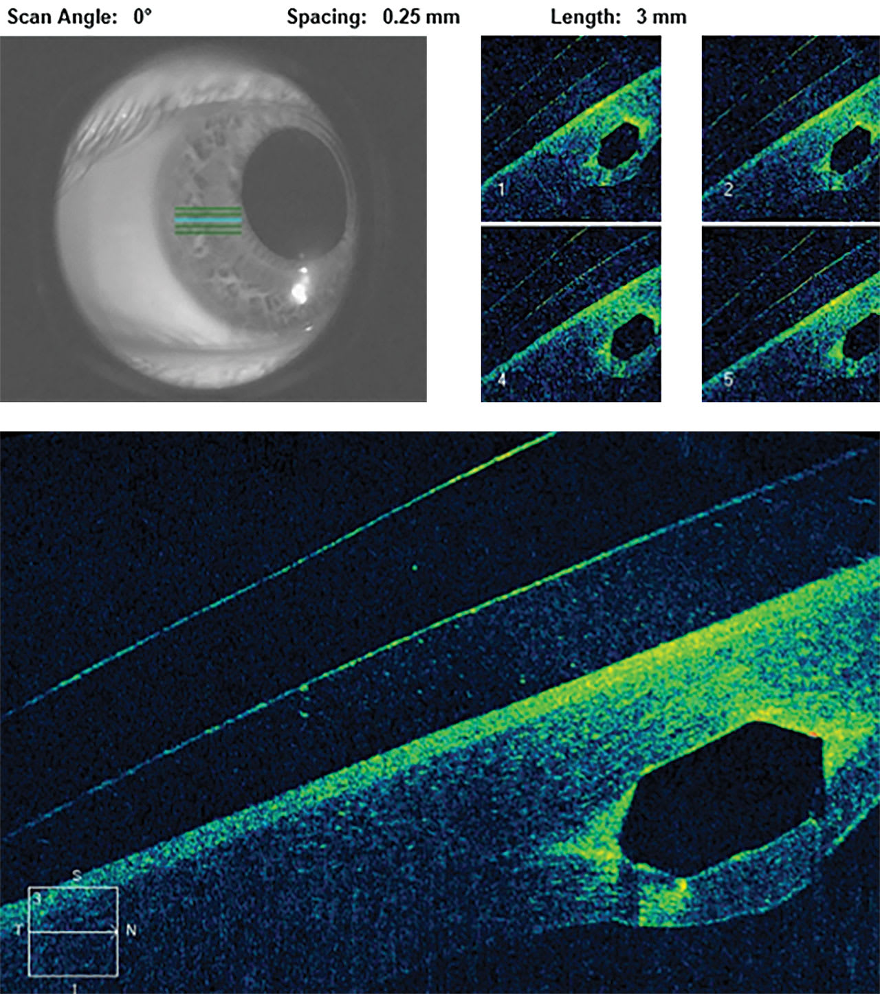 Note how this scleral lens fit over a cornea that underwent intrastromal corneal ring segment surgery. (Photo courtesy: Dr. McKinnis)