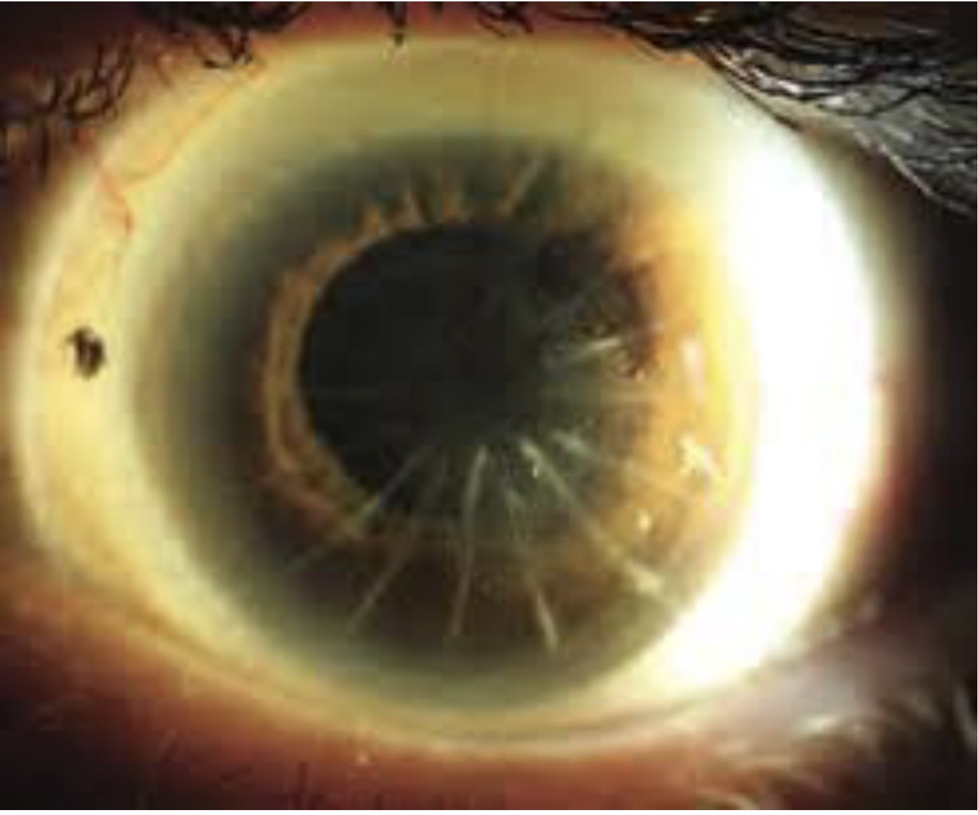 Do you have YAG in the bag?