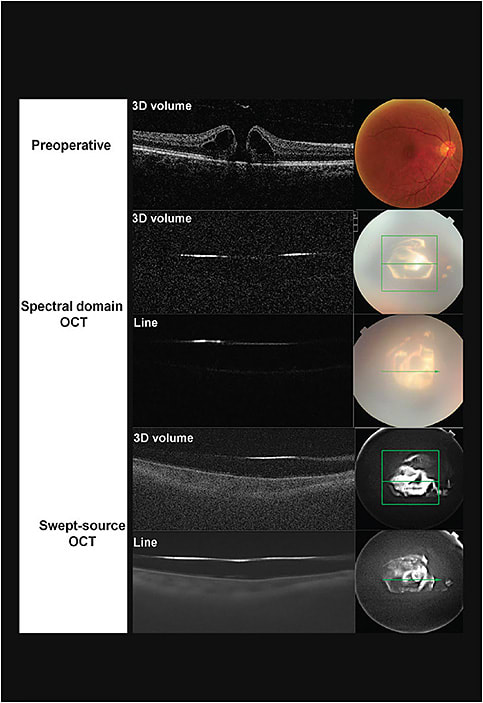 Pre- and Post-Op images
TOP: A pre-operative SD-OCT and fundus photographic image of a macular hole in a 60-year-old male. MIDDLE: 3D images of SD-OCT one day after vitrectomy, internal limiting membrane peeling and gas tamponade. Because the retinal structures are barely visible, the hole closure can’t be evaluated. BOTTOM: 3D images of SS-OCT (DRI-OCT, Topcon Inc) at one day after macular surgery. Both show that the macula’s retinal structures and the status of the hole can be evaluated.
Image courtesy of Topcon