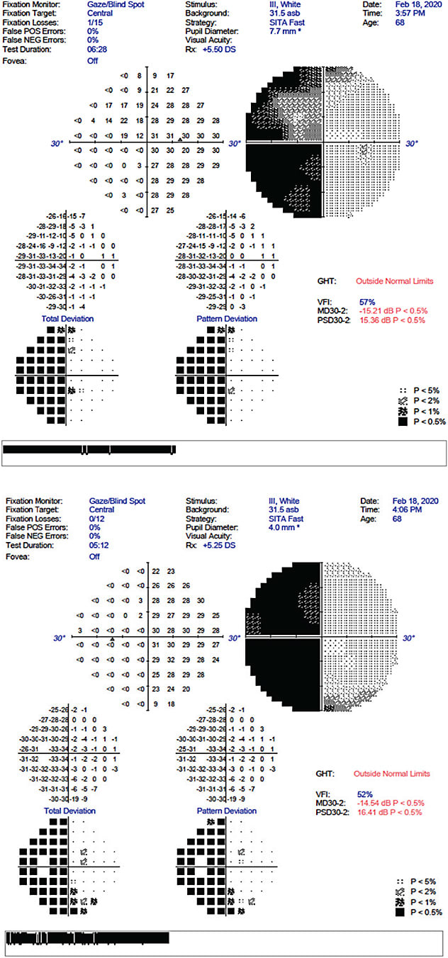 Central 30-2 threshold VF test showing left homonymous hemianopsia OU, with mild sparing of the superior nasal visual field OD.