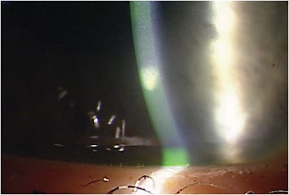 Corneal ulcer. Dr. Miller shows patients examples of bad contact lens-care events, such as corneal ulcers and infections.
Courtesy of Jason Miller, O.D.