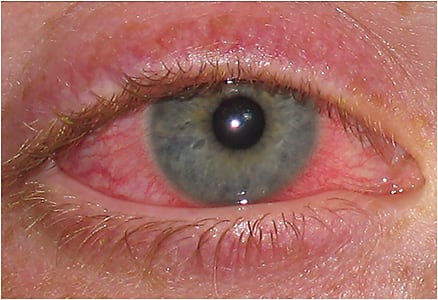 Note the circumlimbal injection and limbal edema in this CLARE patient.
PHOTO CREDIT: SUSAN KOVACICH, O.D.