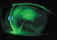 A GP lens fit on a post-RK eye.