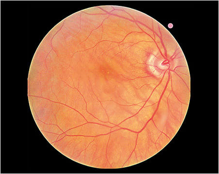 Subretinal drusenoid deposits, shown here, cause severe DA impairment.Photo courtesy of Dr. Legge.