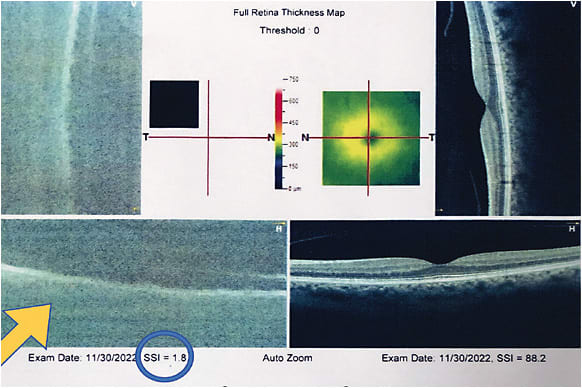 Figure 3. OCT of a patient with dense cataract OD; note the unreliable signal strength of 1.8 as circled in blue (should be ≥45 for reliability with this instrument; was 88.2 for OS in comparison), and the grainy, poor image quality OD (orange arrow) versus OS.Photo courtesy of Dr. Wroten