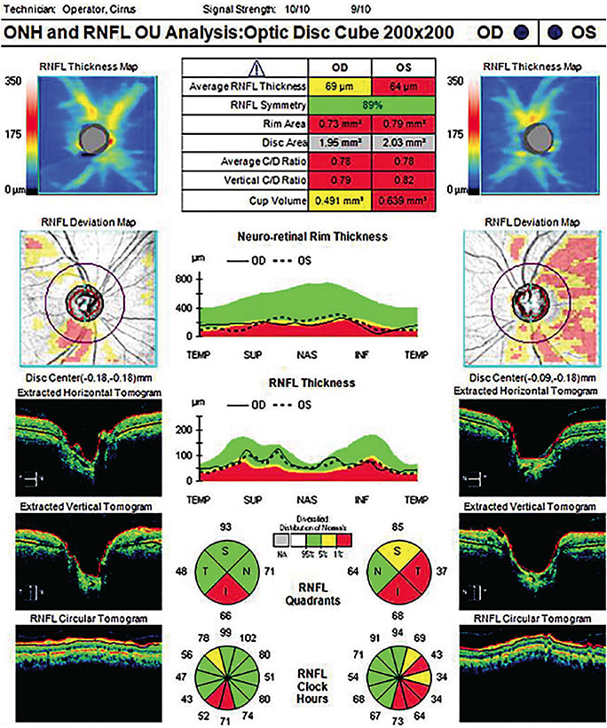 Diffuse RNFL loss with correlating OCT RNFL thinning. 
Image courtesy of Dr. Lifferth