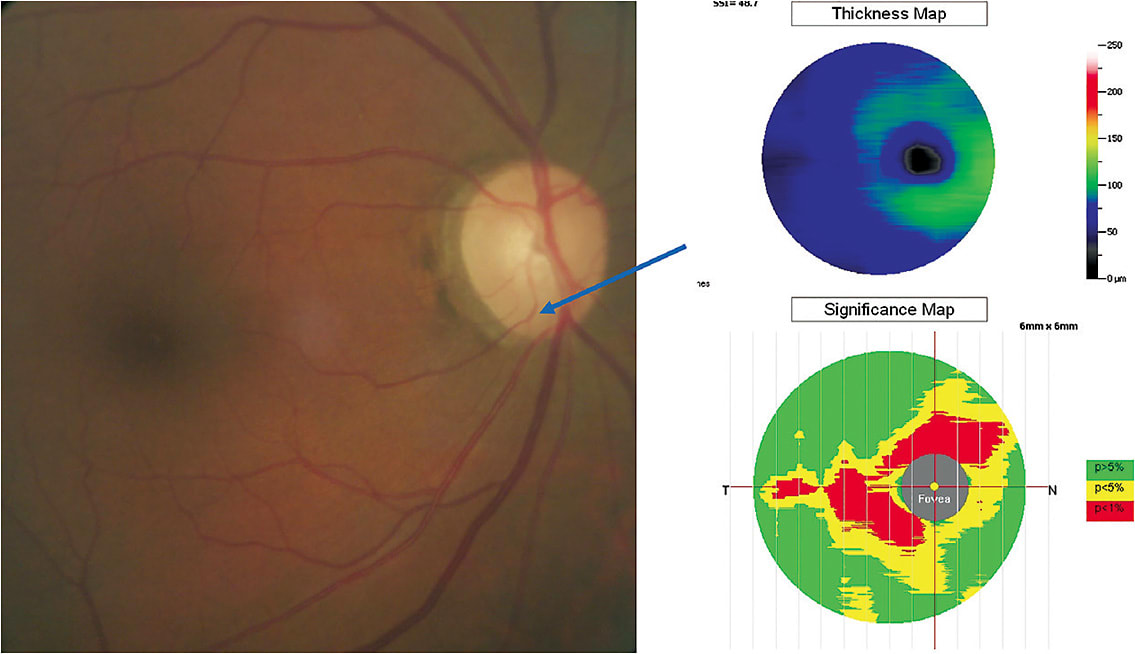Figure 1. Right color fundus photograph with arrow indicating a vessel deflection describing a thinner inferior rim than had been documented previously. Right panel showing absolute macular nerve fiber layer thinning (thickness map) based on the color scale to the right and relative thinning based on the reference database (less than 1% of those with such a thin value). 
All images courtesy of Leo Semes, O.D., F.A.A.O.