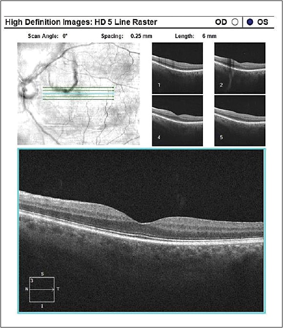 Pre: Note in upper left-hand image, the floater over the macula, and in the upper right-hand image, a shadow cast from a floater.Courtesy of Dr. I. Paul Singh