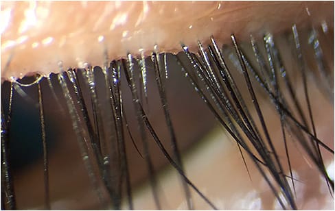 Collarettes can be easily overlooked, yet are pathognomonic for Demodex blepharitis. Ensure patients look down for a full lid and lash health assessment.Photo courtesy of Dr. Selina R. McGee.