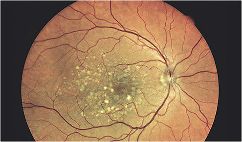 Photo Courtesy of Steven Ferrucci, O.D., F.A.A.O.