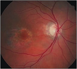 Saucerization of the subfoveal area.
Courtesy of Diana L. Shechtmsn, O.D., F.A.A.O.