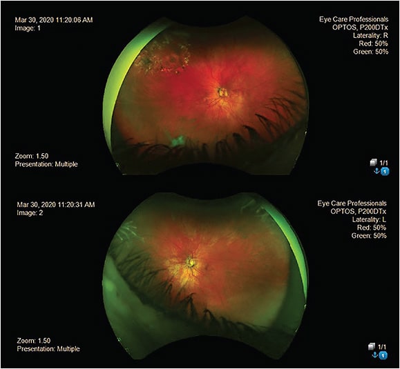 The patient’s history included a retinal tear. Images courtesy of Dr. Jason R. Miller.