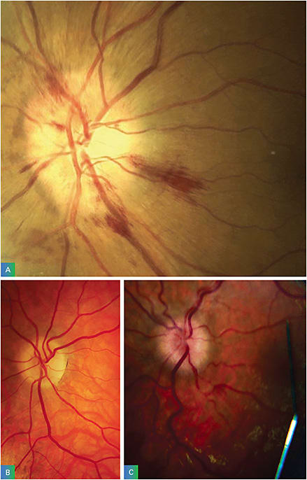 A: Patients who have been diagnosed with glaucoma can actually have others forms of an optic neuropathy, such as anterior ischemic optic neuropathy. B: Optic nerve meningioma and C: papilledema are also differential diagnoses related to neuro.
Images courtesy of A: Mohammed Raffieetary, O.D.; B: Austin Lifferth, O.D.; C: Austin Lifferth, O.D.