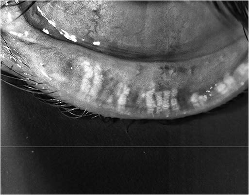 Meibography image of a cataract patient who had significant shortening and dropout of the meibomian glands.