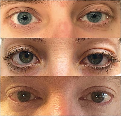 Examples of patients presenting with ptosis. From top to bottom, the patients are: 24-year old male, mild to moderate ptosis OS; 26-year old female, moderate to severe ptosis OS; 39-year old male, mild ptosis OD.
All images courtesy of Dr. Lighthizer.