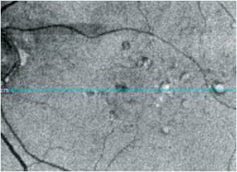 En-face OCT image appears similar to fundus autofluorescence in a patient with non-exudative AMD.
Courtesy of Dr. Jessica Steen