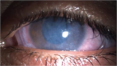 A cryopreserved amniotic membrane on a patient who has severe DED.