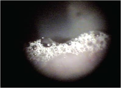 Staph. overpopulation is a frequently overlooked driver of tear dysfunction, due to saponification, seen here, and degradation of tear lipids.
PHOTO CREDIT: Art Epstein, O.D. F.A.A.O.