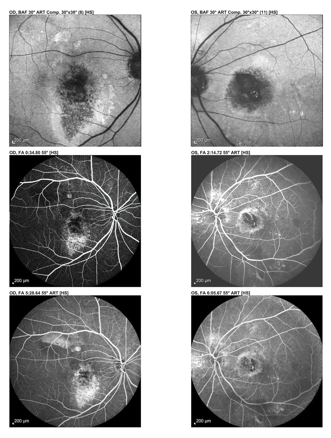 Note the fluorescein angiography demonstrating early macular hyperfluorescence, indicative of active choroidal neovascularization, followed by progressive late-phase leakage and persistent hyperfluorescence with associated dye pooling and staining. These findings are characteristic of exudative (wet) age-related macular degeneration. (Photo courtesy: Dr. Murthy)