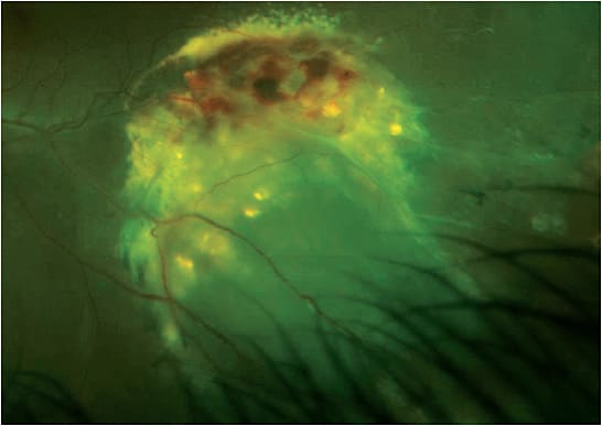 Note the exudative neurosensory detachment with retinal hemorrhage and an associated elevated fibrotic reddish lesion in the inferior temporal peripheral retina OS.
Courtesy of Dianna Shechtman, O.D., F.A.A.O.