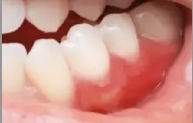 Gum disease is associated with AMD?