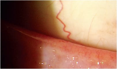 Subtle MGD with capping of glands along the lid margin.
