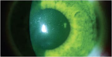 Figure 2. Bandage soft contact lens on eye after CXL. Image coutesy of Dr. Clark Chang.
