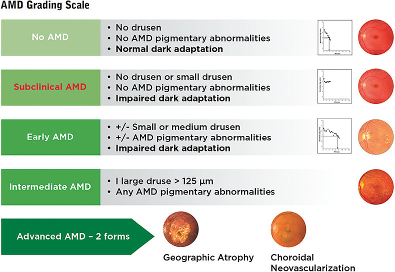 Figure 3. Subclinical AMD can be added to the familiar grading scale.
Graphic courtesy of MacuLogix.