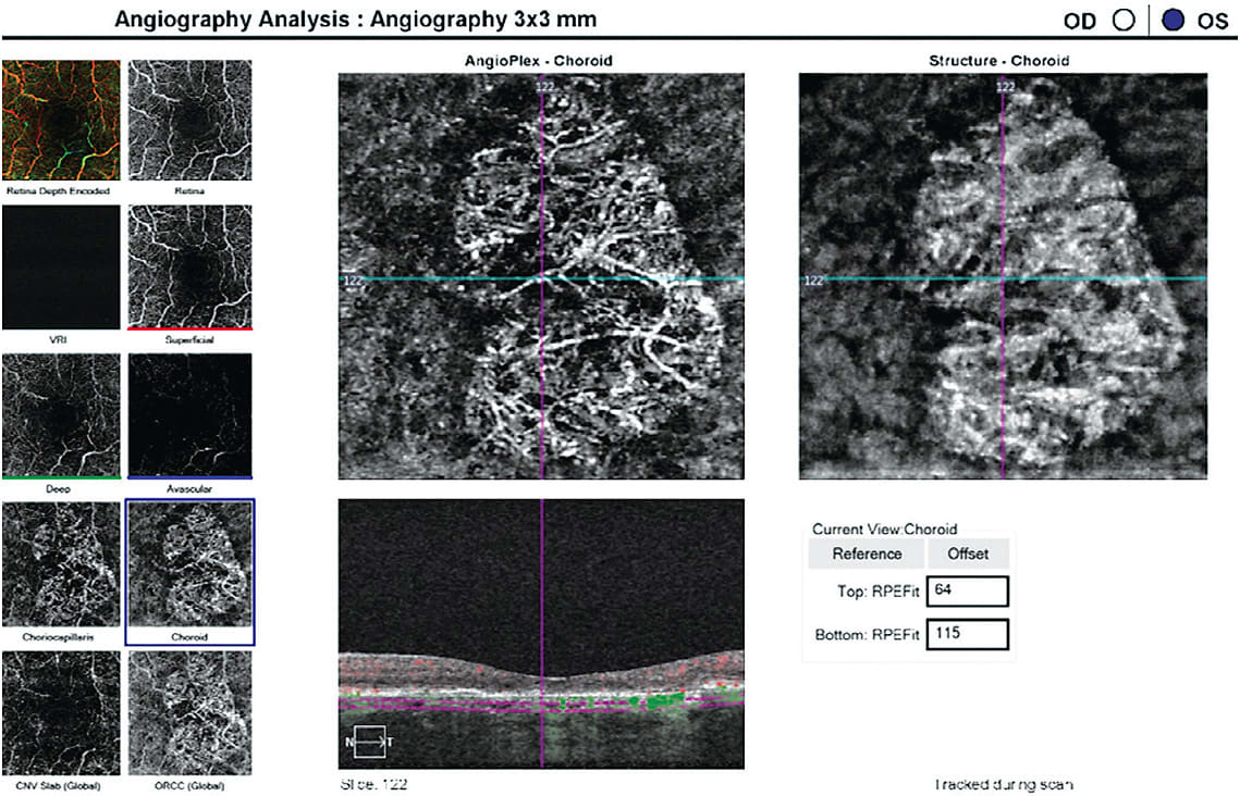 OCT-Angiography reveals a non-leaking occult CNVM, requiring a referral. Image courtesy of Dr. Elizabeth Steele.