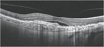Figure 1. OCT shows drusen with underlying disruption of Bruch’s membrane. Images courtesy of Dr. Michael Cymbor.