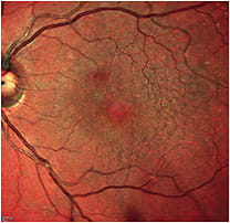IMAGE: Multicolor image, grid-like visible reticular drusen.