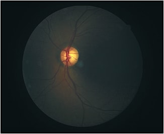 Optic nerve pallor present OS
Courtesy of Dr. Diana Shechtman