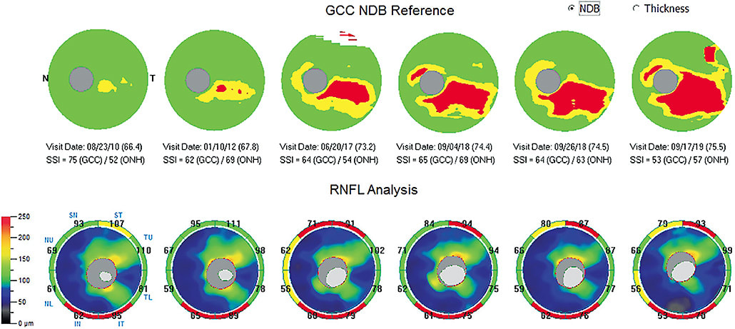 Figure 5. OCT shows progression in both the ganglion cell complex (GCC) and the retinal nerve fiber layer (RNFL). Images courtesy of Dr. Michael Cymbor.