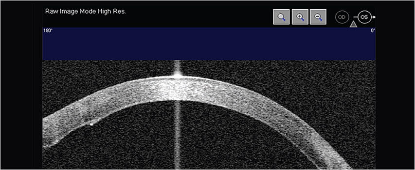 A fully reattached Descemet’s membrane endothelial keratopathy graft, via AS-OCT, after air bubble injection to re-attach the graft.
All Images courtesy of Dr. Josh Johnston