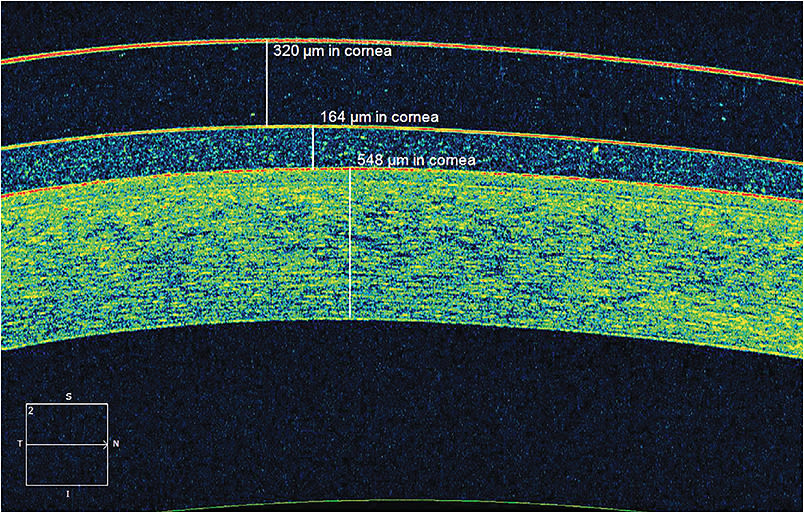 Anterior segment OCT evaluating corneal thickness, pre-corneal tear film and corneal thickness.