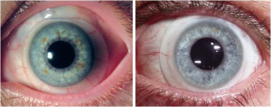 Figure 2. Today’s scleral contact lens materials are highly biocompatible and comfortable for patients.