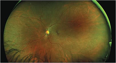 Image courtesy Mohammad Rafieetary, OD, FAAO, FORS, Dipl ABO &amp; ABCMO