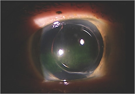 Note the band SPK on this dry eye disease patient. Image courtesy of Dr. Savannah Long