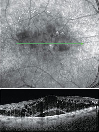 Note the SD-OCT of this patient who presented with center-involved DME. VA was 20/100. 
Images courtesy of Dr. Sherrol A. Reynolds