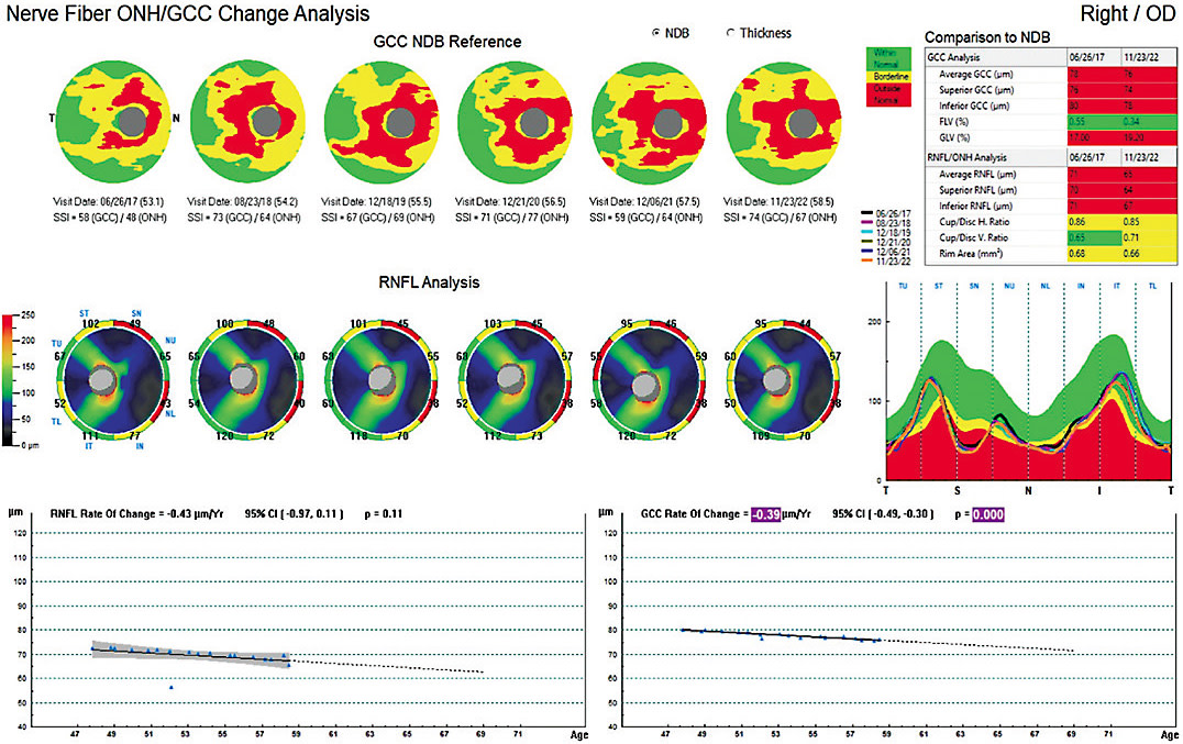 Figure 4. An image showing the change analysis of the RNFL and GCC over five years’ time. This can assist in the determination of stability vs. progression of the current disease state and the need for additional therapy vs. continuing the current management plan.Photo courtesy of Dr. Wroten