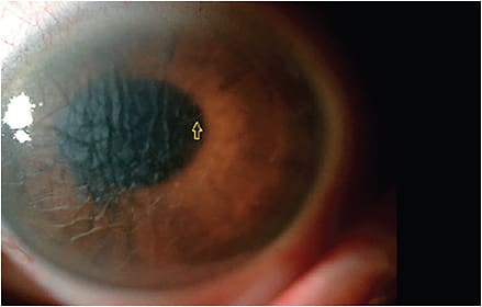 Note the edema in this Descemet membrane flap tear patient.
Photo courtesy of Josh Johnston, O.D., F.A.A.O.