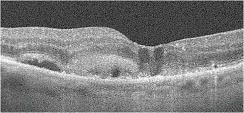 Note the double layer sign, subretinal hyperreflective material, and intraretinal fluid. Photo courtesy of Dr. Legge.