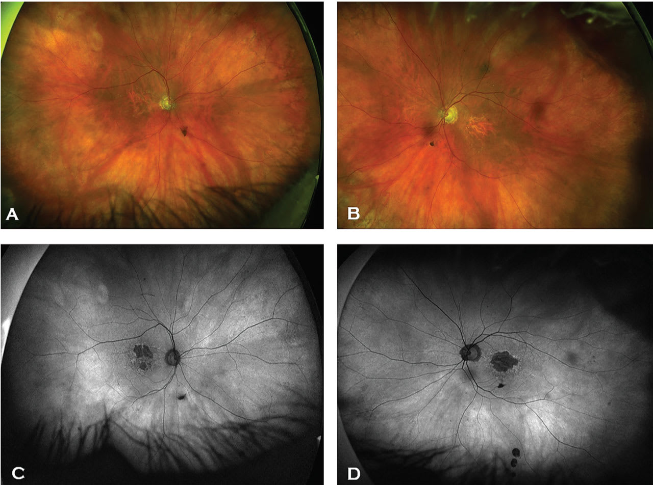 Figure 1. Note the geographic atrophy on color fundus photography and fundus autofluorescence. See the well-demarcated area of visible choroid in the right and left eye (A, B). See hypofluorescence with hyperfluorescent ring (C, D). (Photo courtesy: Dr. Kinzer)