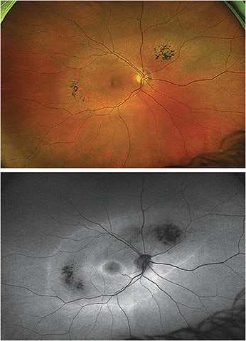 Note the color and gray scale images of the patient’s retinitis pigmentosa. Images courtesy of Dr. Yu.