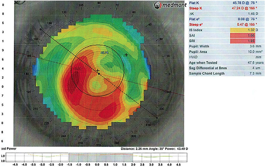 Image from our new topographer, an upgrade because it provides our technicians with more data, including the HVID, prior to a specialty contact lens fit. Additionally, the device streamlines the fitting process and provides an improved initial fit.
Image courtesy of Dr. Jason Miller