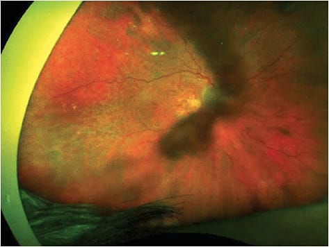 Figure 7. An 82-year-old female presented with geographic atrophy that had caused severe vision loss in both eyes, and further acute vision loss in the right eye as seen in this optomap image.