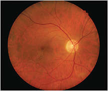 IMAGE: Epiretinal membrane due to posterior vitreous detachment with floater.