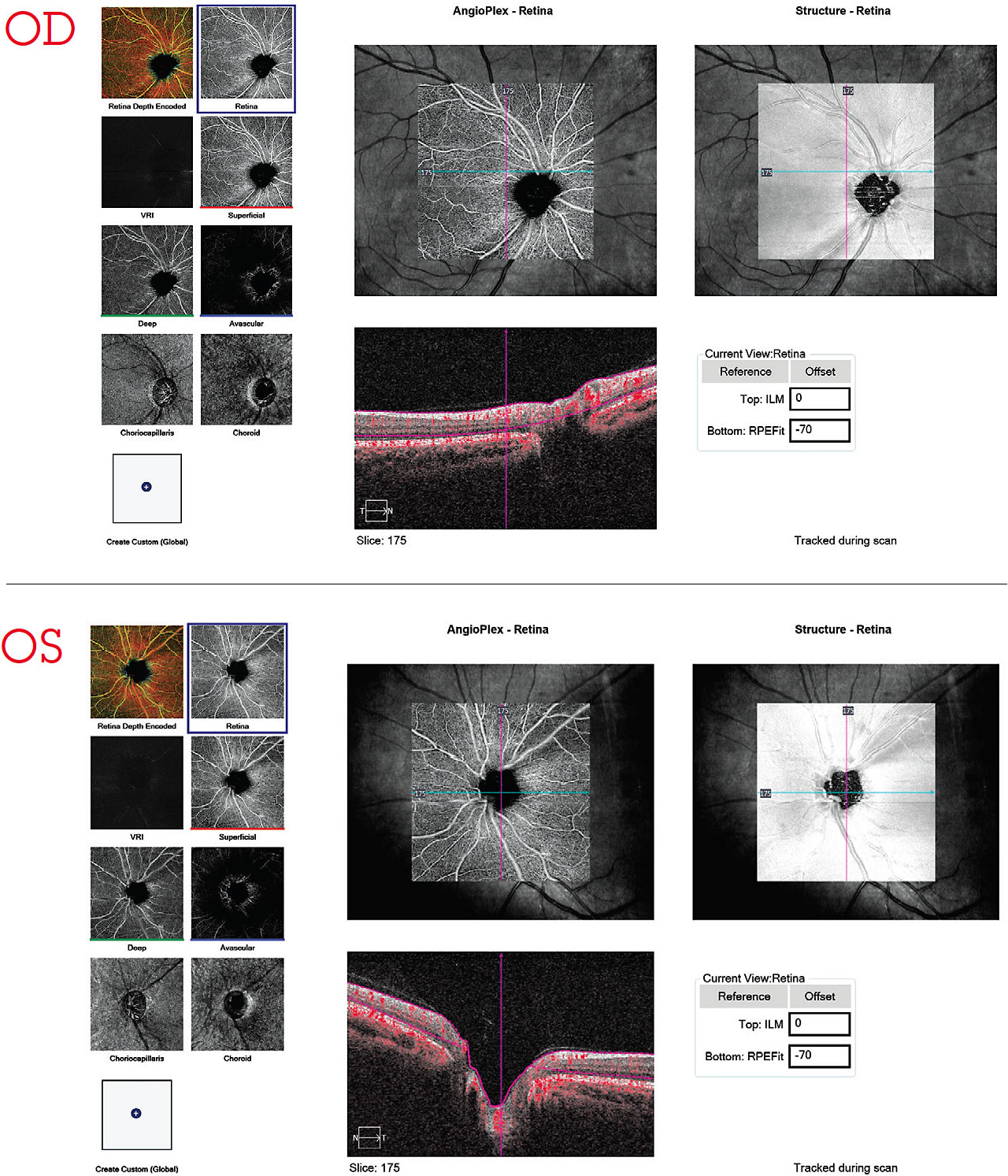 Note: On the OD (top), blood vessel drop-off at the 7 o’clock spot; on the OS (bottom), blood vessel drop-off from around the 12:30 o’clock spot to 2 o’clock. 
Courtesy: Aaron Lech, O.D., F.A.A.O.