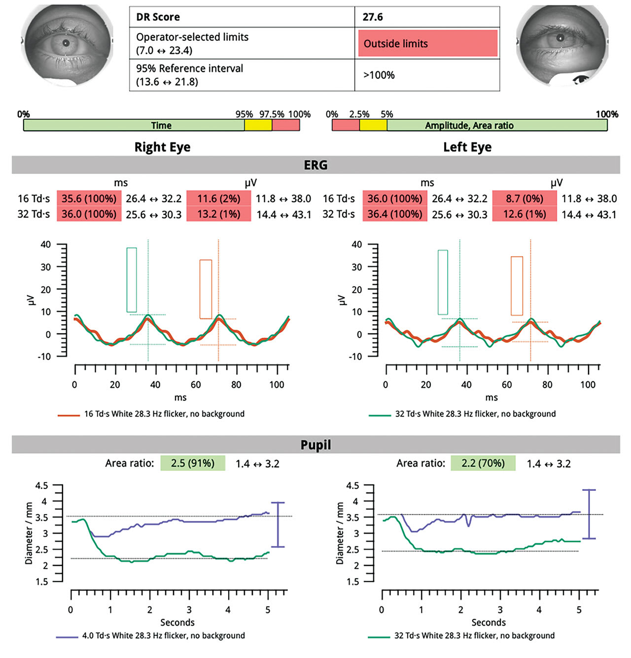A handheld electroretinographer revealed severely delayed implicit time OU, along with severely reduced amplitude OU, and a DR score of 27.6 (Photo courtesy: Dr. Calhoun)